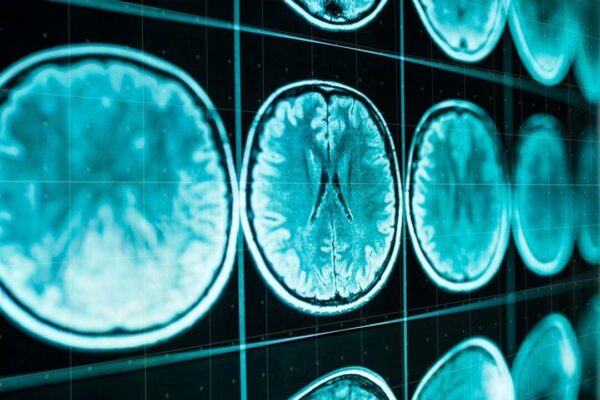 認知症はいつ始まっているのか――診断までの空白