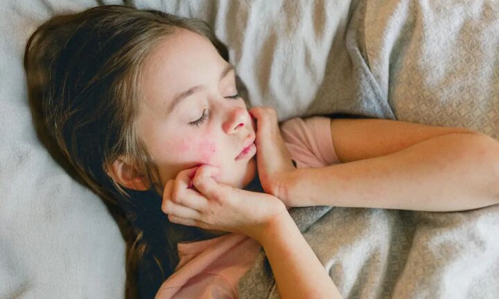 湿疹は単なる皮膚トラブルではない　家庭でできる5つのケア