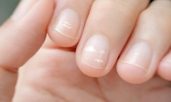 爪の白い点はカルシウム不足？　医師が身体のサインを解説