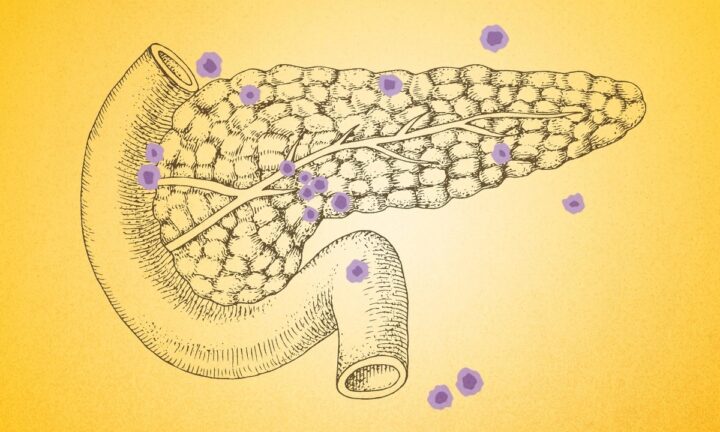 膵臓がんに注意：見落としがちな7つの警告サイン