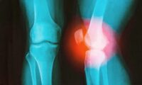 膝を痛めた外科医が見つけた　関節炎に打ち勝つ方法